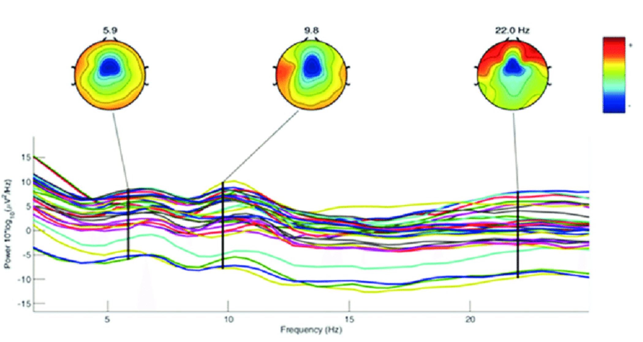 QEEG / Brain Mapping Report and Neurotherapy Recommendations