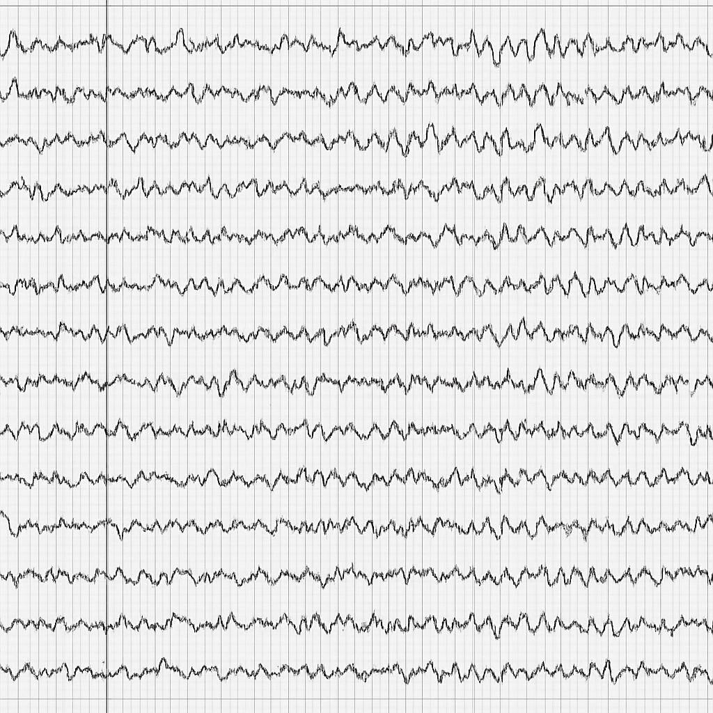 QEEG & ERP - Brain Mapping recording